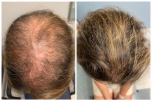 Hair loss and minoxidil treated hairs comparison 