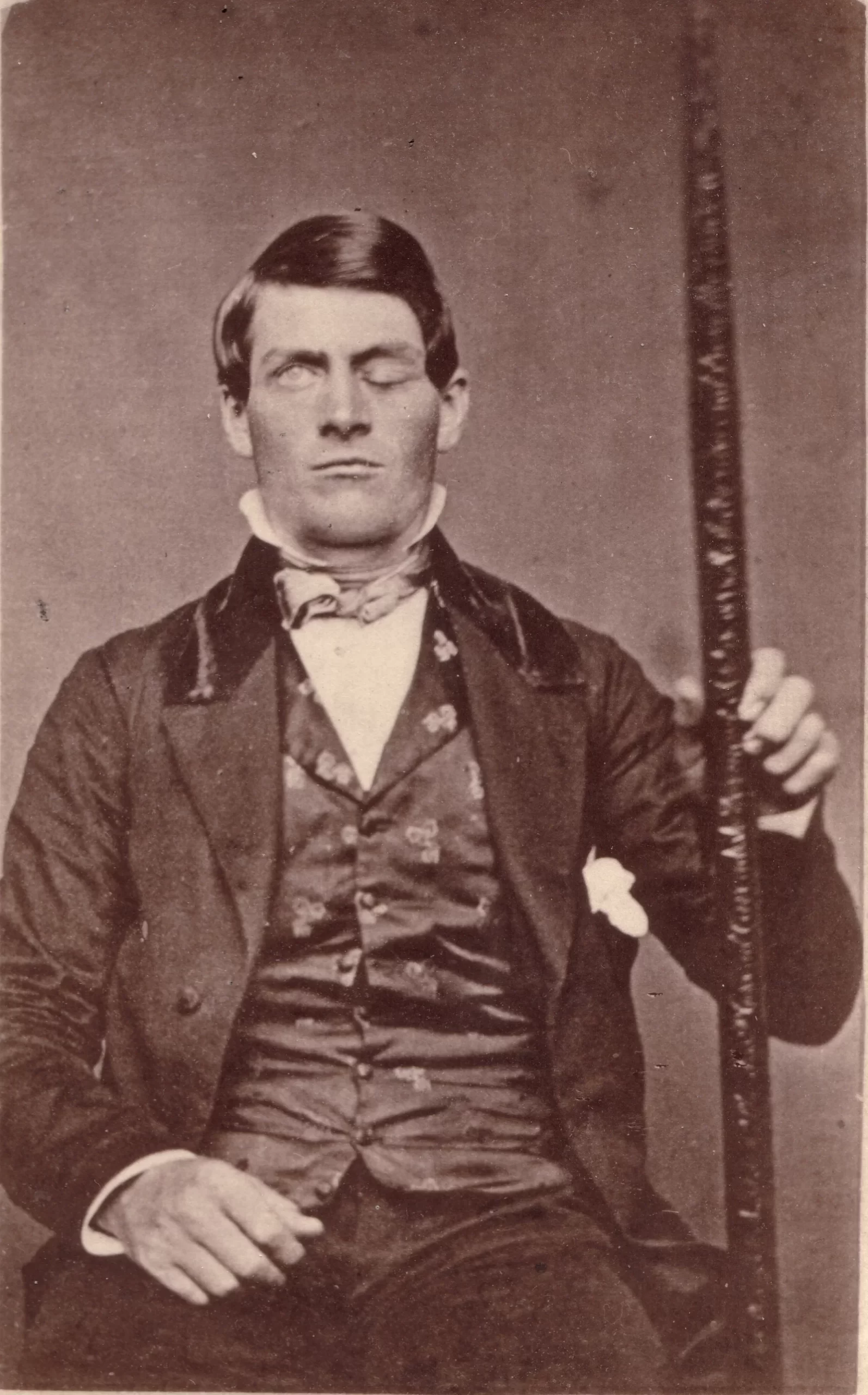 Cabinet-card portrait of brain-injury survivor Phineas Gage (1823–1860), shown holding the tamping iron that injured him. Wikimedia